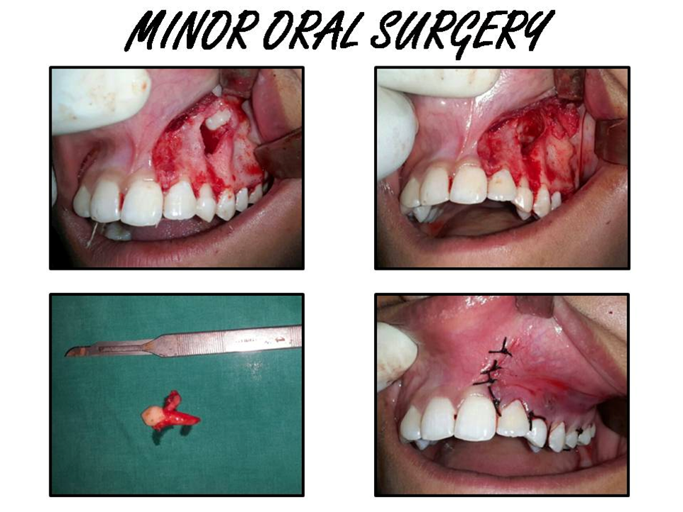 Oral Surgery